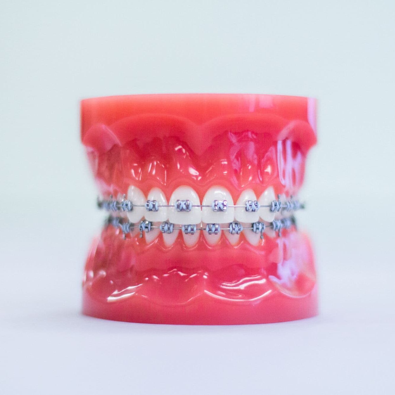 Traditional braces